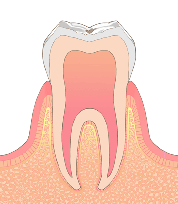 虫歯の進行度C1