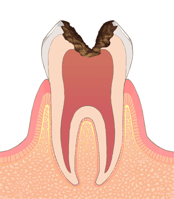 虫歯の進行度C2