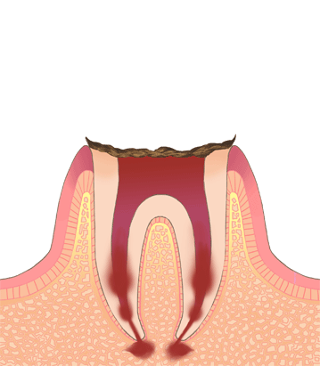 虫歯の進行度C2