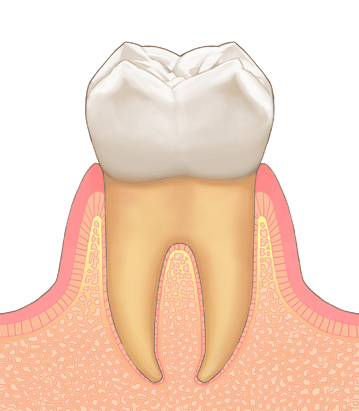 歯周病の進行度1