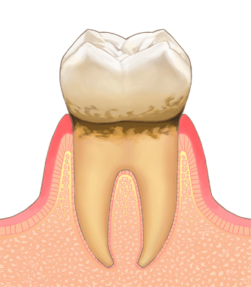 歯周病の進行度2