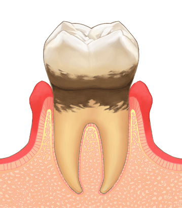 歯周病の進行度3