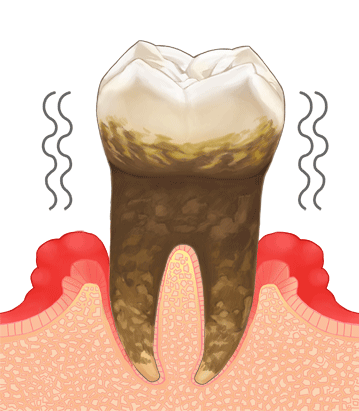 歯周病の進行度4